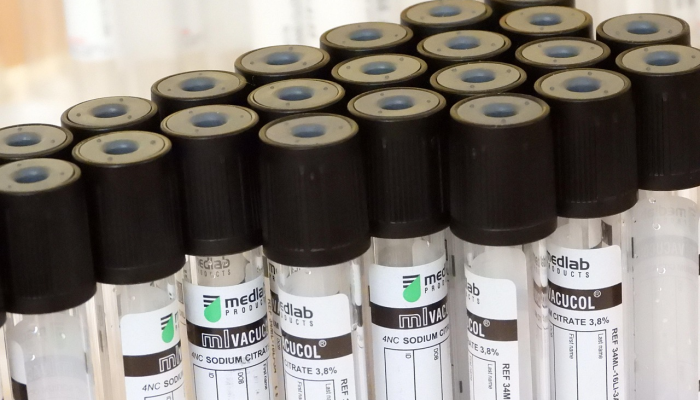 干细胞移植研究成功治愈艾滋病第三人 干细胞移植研究成功治愈艾滋病第三人